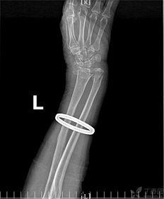 骨折吃小瓜吗,小瓜助力营养补充，加速康复进程